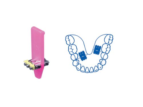 Sicherheitsschlüssel für Dehnschrauben (Safety Key) - ORTHOBY Feldmann  Dental